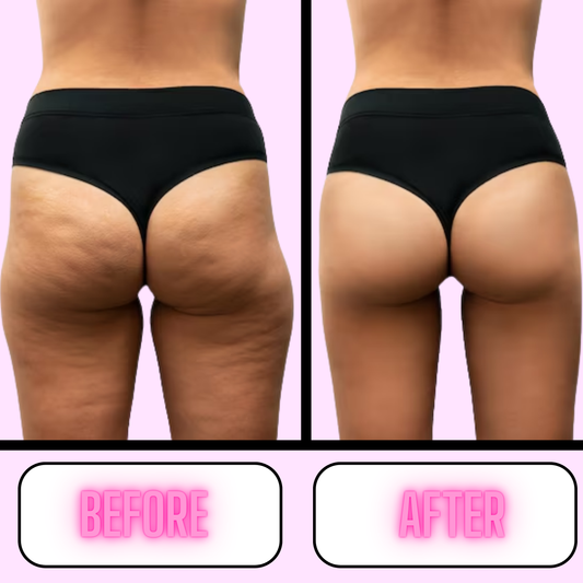 Anti Cellulite Massager